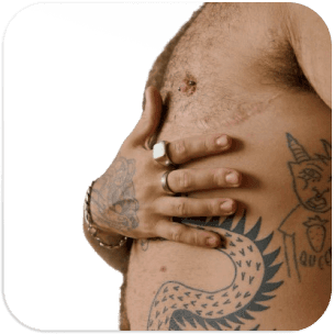 Double Incision Mastectomy